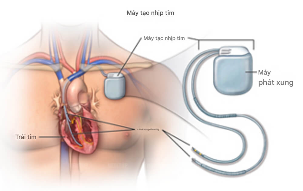 Giới thiệu tổng quan về máy tạo nhịp tim